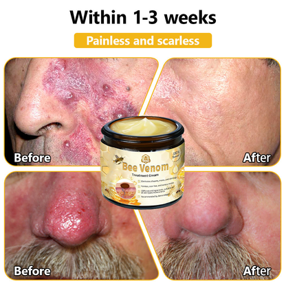 𝗧𝗟𝗢𝗣𝗔® Bee Venom Skin Treatment Cream (AAD Recommended👨‍⚕️)🧡