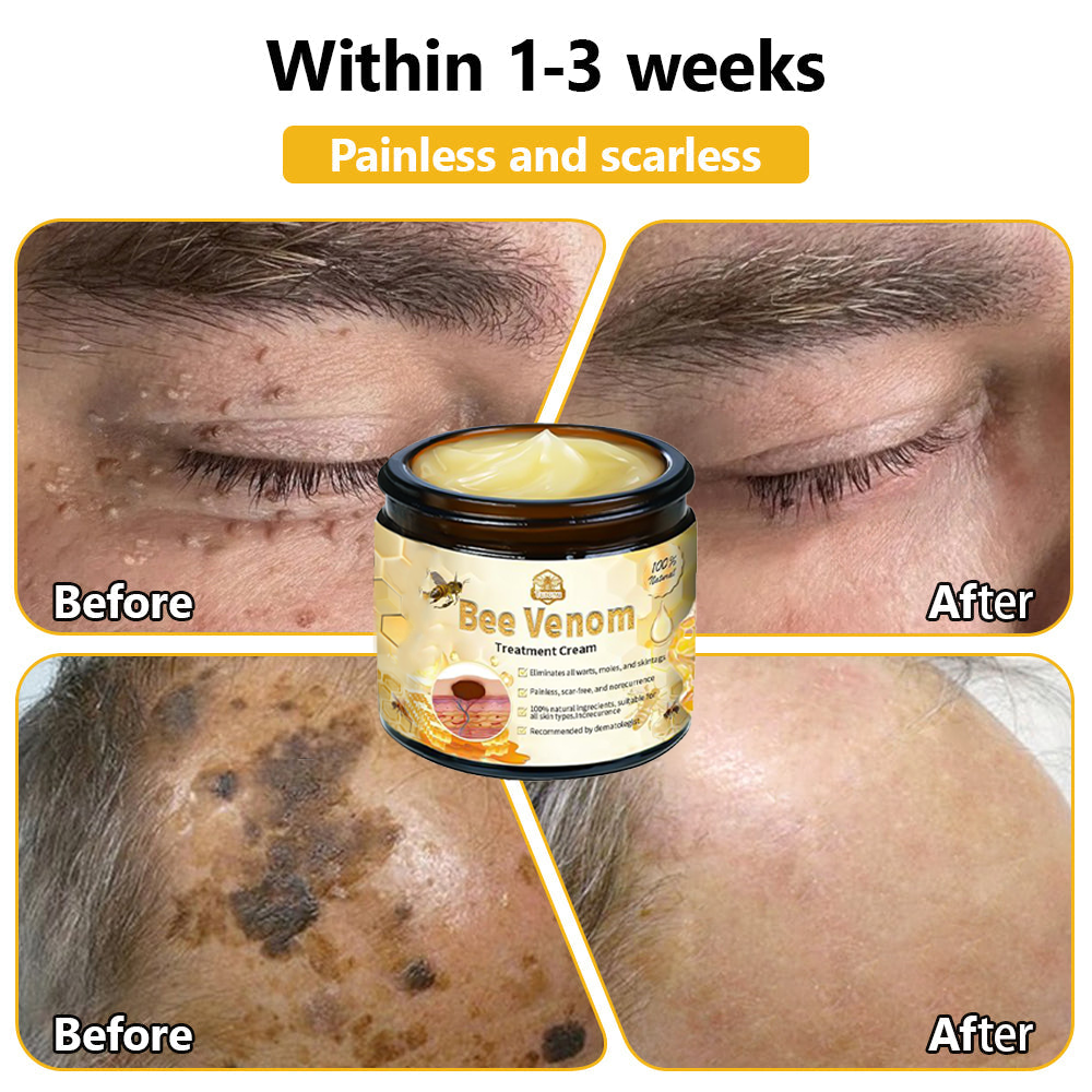 𝗧𝗟𝗢𝗣𝗔® Bee Venom Skin Treatment Cream (AAD Recommended👨‍⚕️)🧡