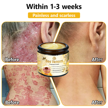 𝗧𝗟𝗢𝗣𝗔® Bee Venom Skin Treatment Cream (AAD Recommended👨‍⚕️)🧡