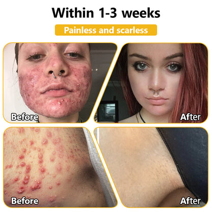 𝗧𝗟𝗢𝗣𝗔® Bee Venom Skin Treatment Cream (AAD Recommended👨‍⚕️)🧡